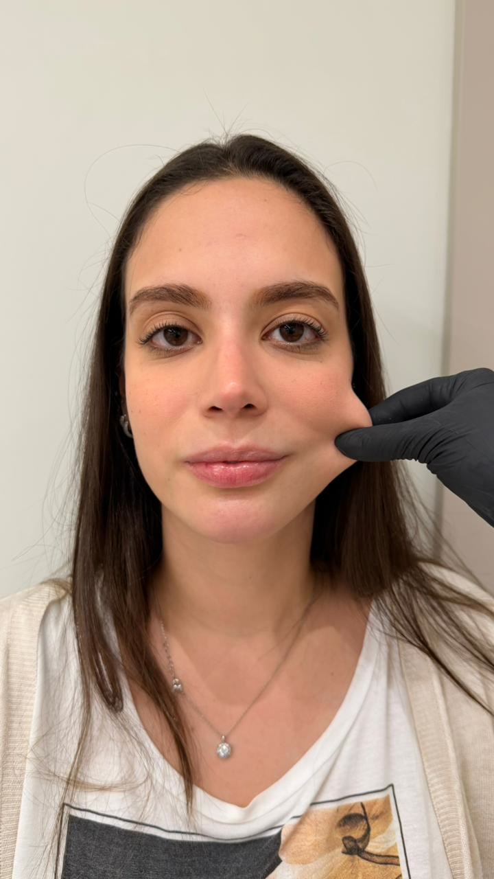Paciente da clínica em tratamento com bioestimulador de colágeno