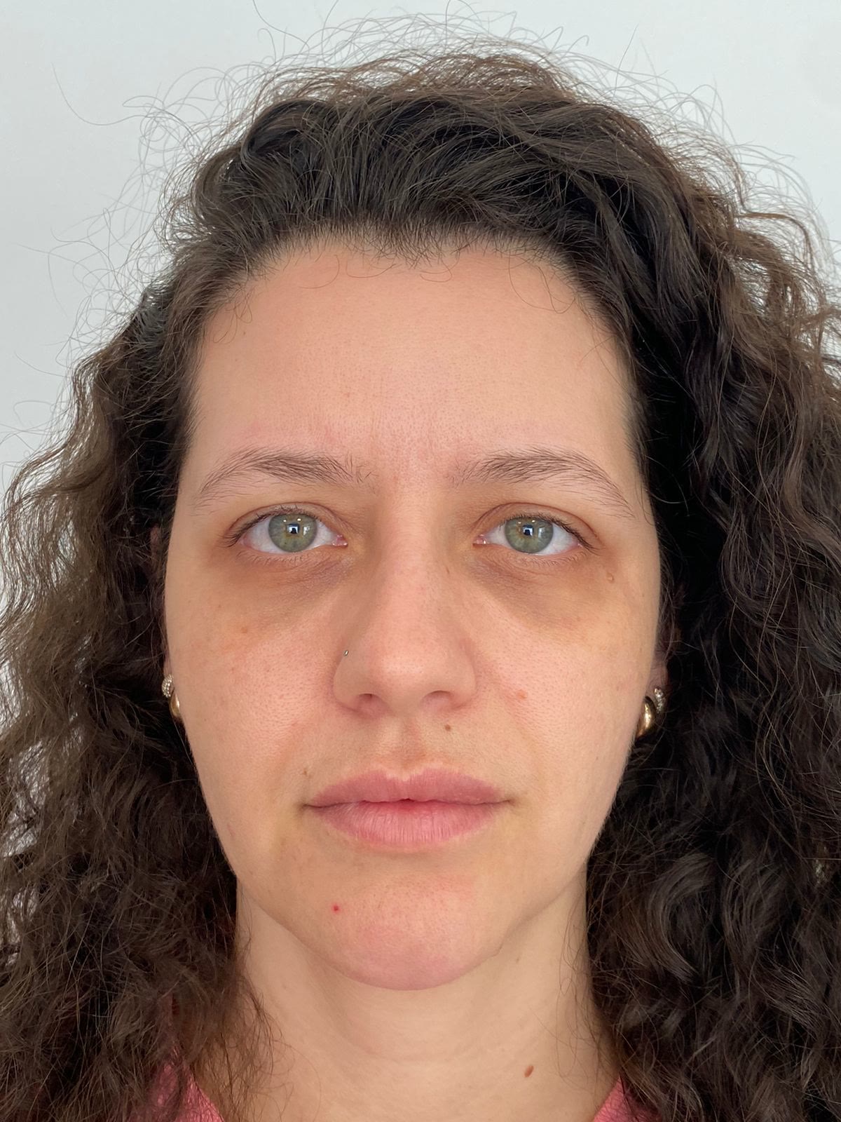 Paciente da clínica após tratamento com Laser Lavieen