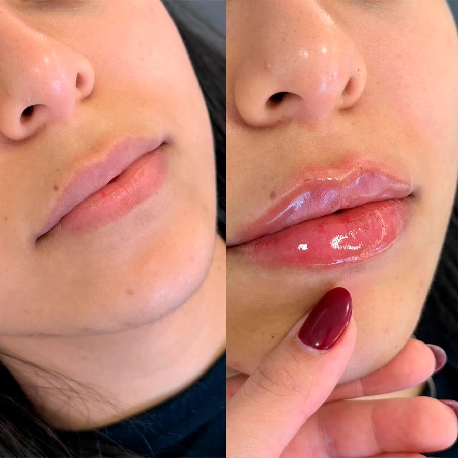 Antes e depois de preenchimento labial em paciente da clínica
