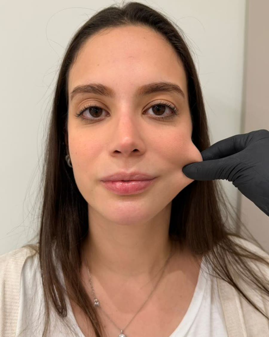 Depois do tratamento de bioestimulador de colágeno
