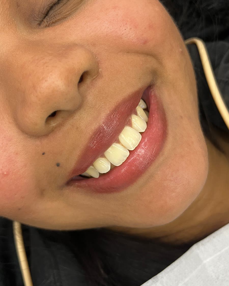 Antes do tratamento de clareamento dental