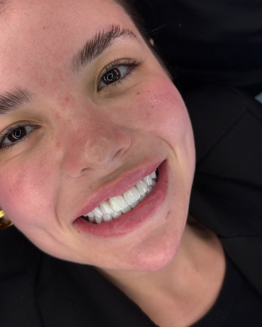 Depois do tratamento de lentes em resina estratificada