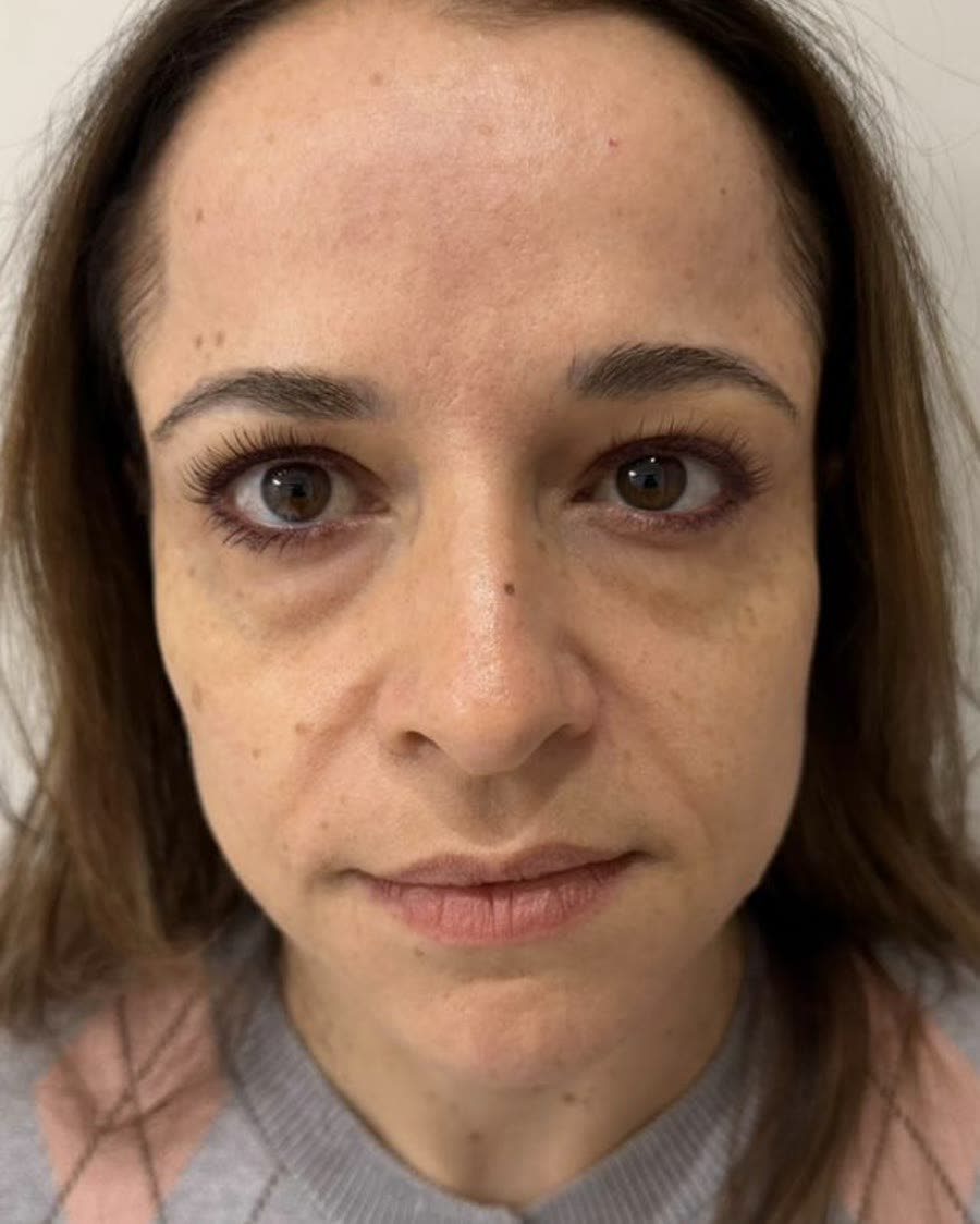 Antes do tratamento de reestruturação facial